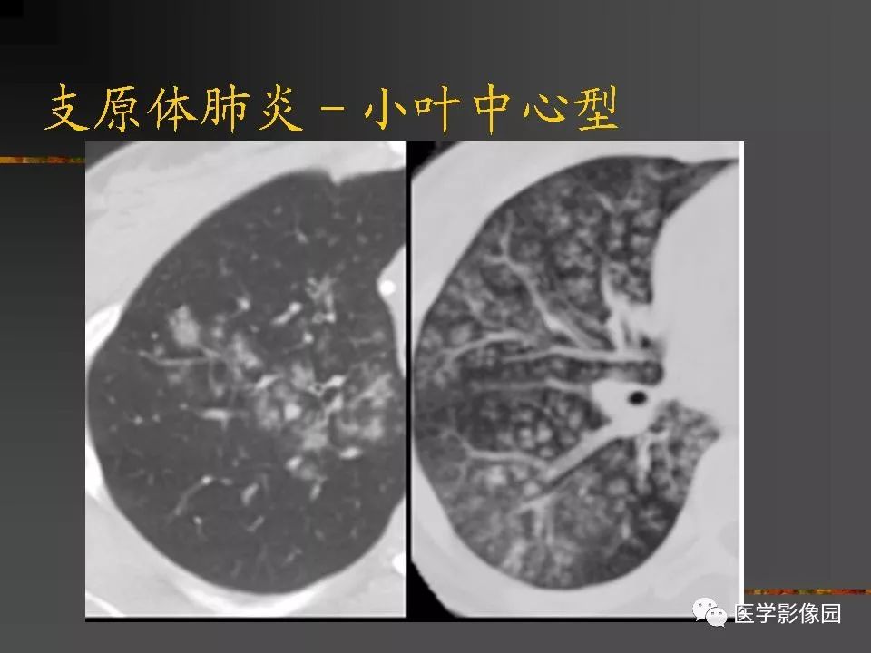 【PPT】间质性肺疾病及其影像诊断