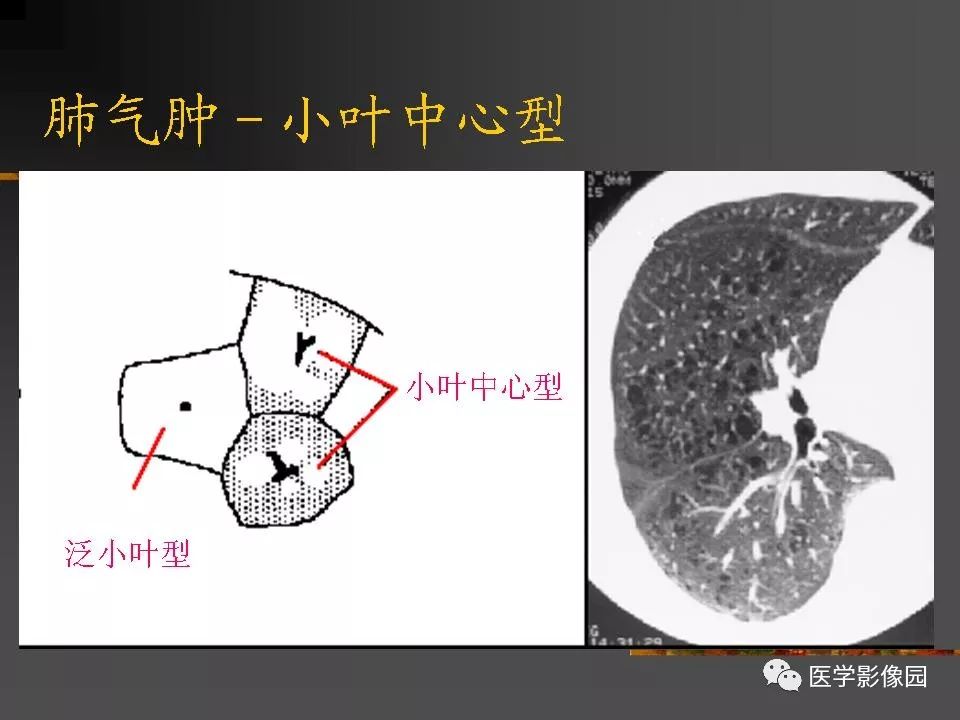 【PPT】间质性肺疾病及其影像诊断
