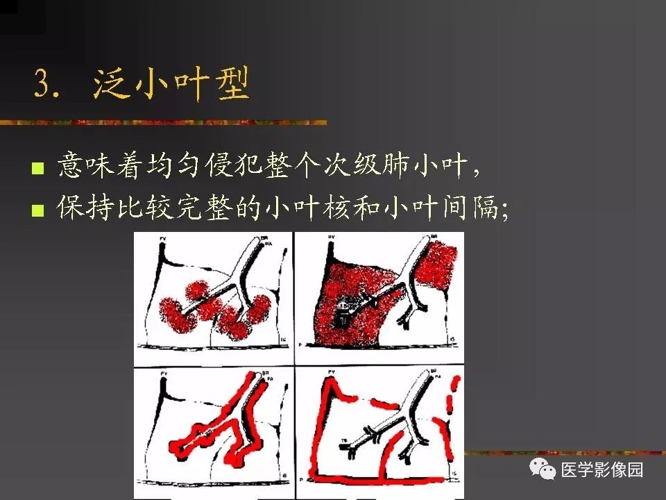 【PPT】间质性肺疾病及其影像诊断