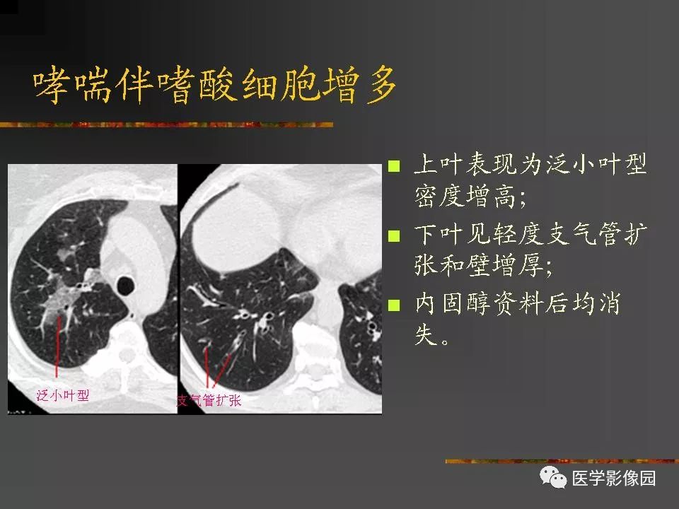 【PPT】间质性肺疾病及其影像诊断