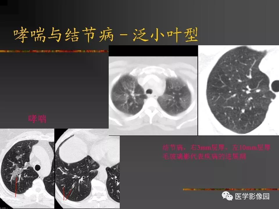 【PPT】间质性肺疾病及其影像诊断