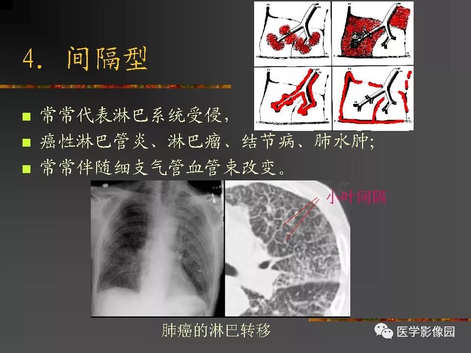 【PPT】间质性肺疾病及其影像诊断
