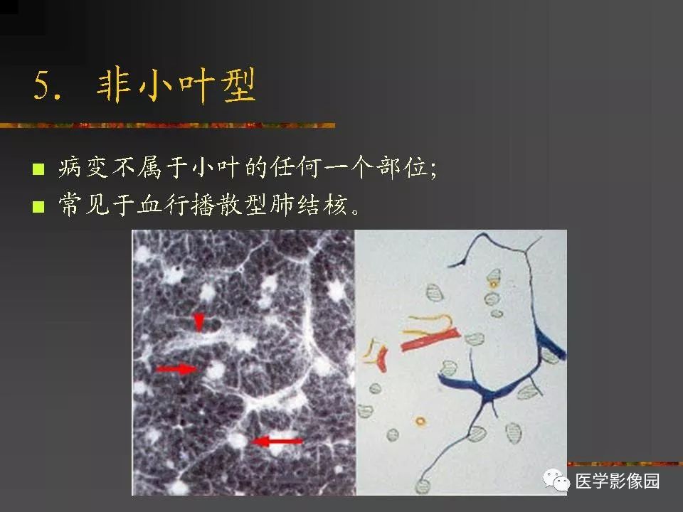【PPT】间质性肺疾病及其影像诊断