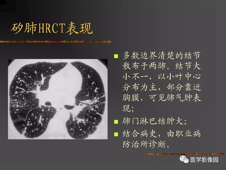【PPT】间质性肺疾病及其影像诊断