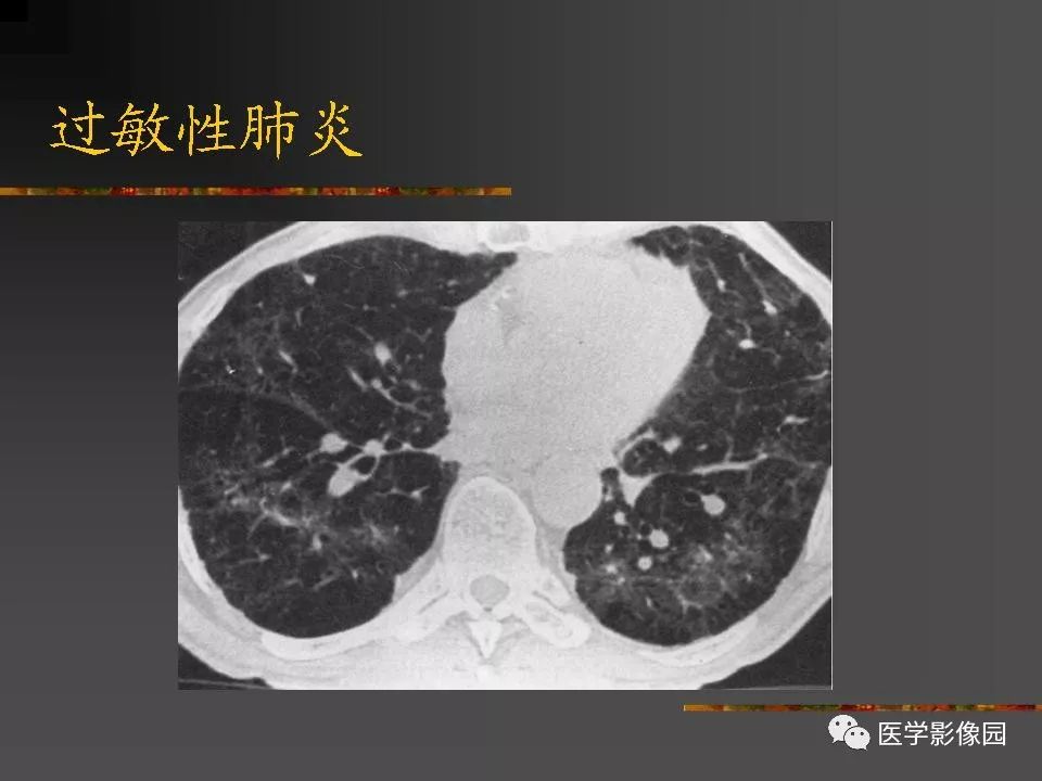 【PPT】间质性肺疾病及其影像诊断