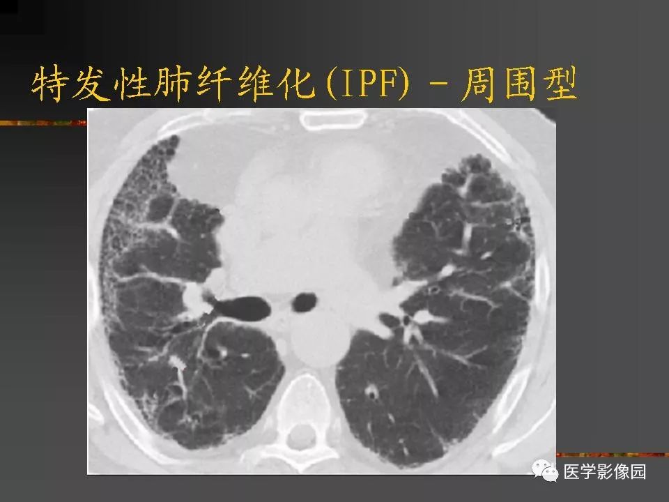 【PPT】间质性肺疾病及其影像诊断