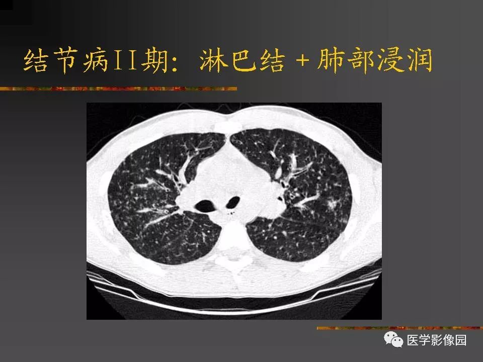 【PPT】间质性肺疾病及其影像诊断