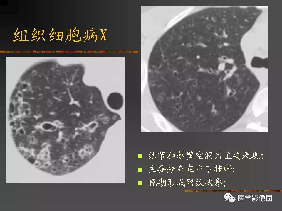 【PPT】间质性肺疾病及其影像诊断