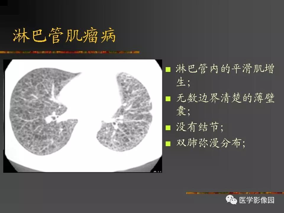 【PPT】间质性肺疾病及其影像诊断