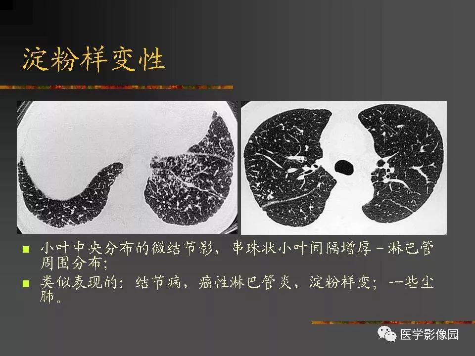 【PPT】间质性肺疾病及其影像诊断