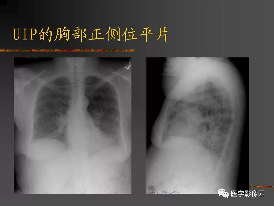 【PPT】间质性肺疾病及其影像诊断
