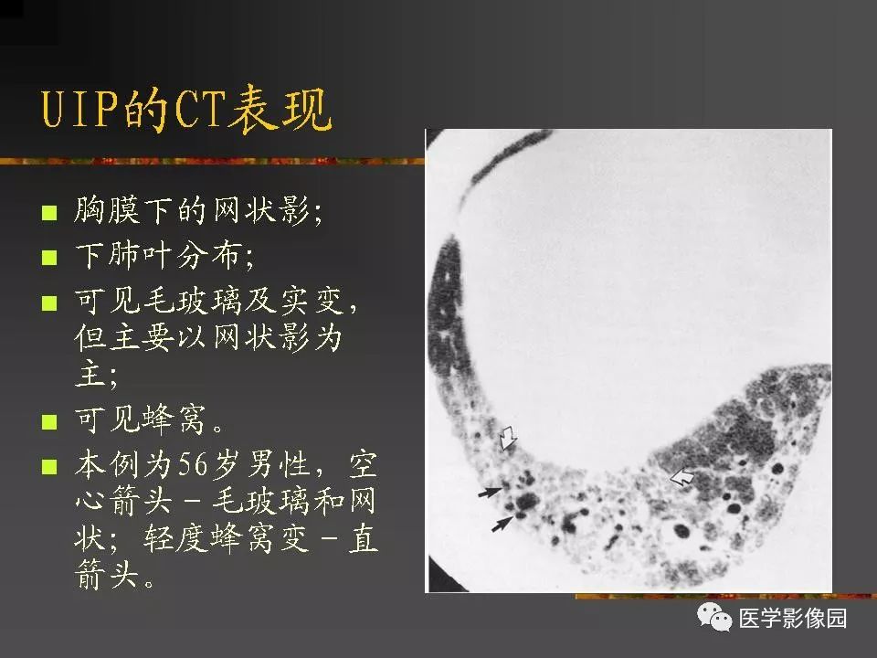【PPT】间质性肺疾病及其影像诊断
