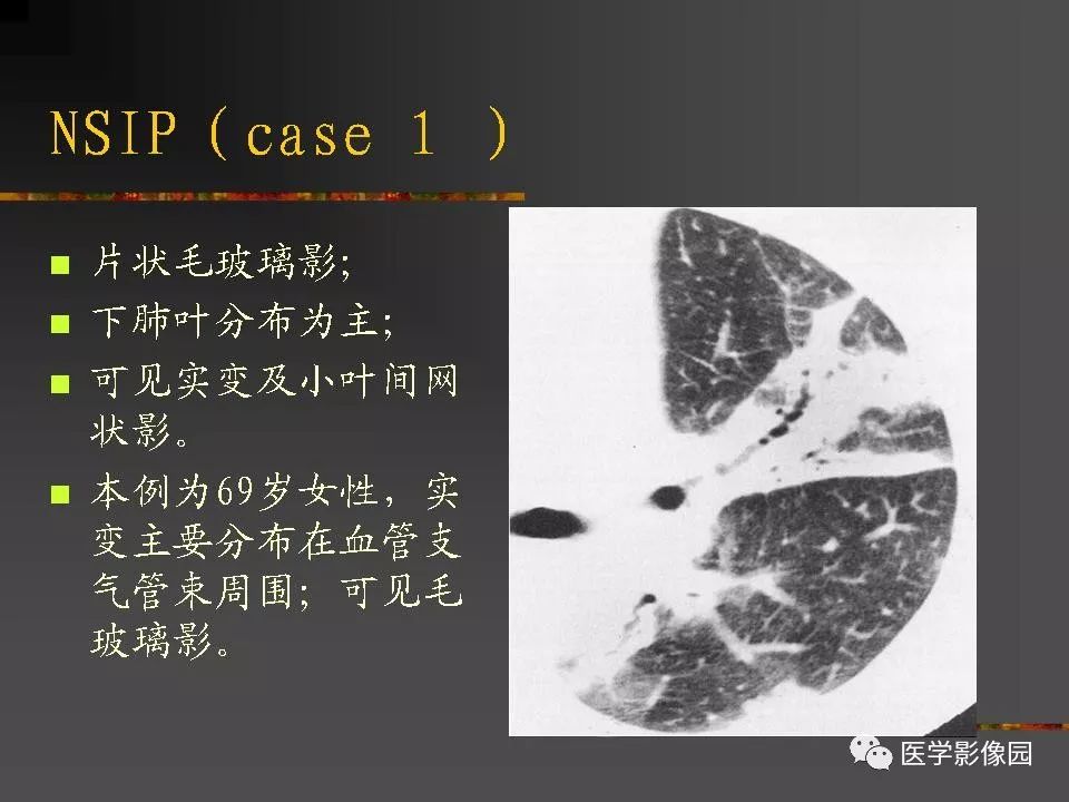 【PPT】间质性肺疾病及其影像诊断