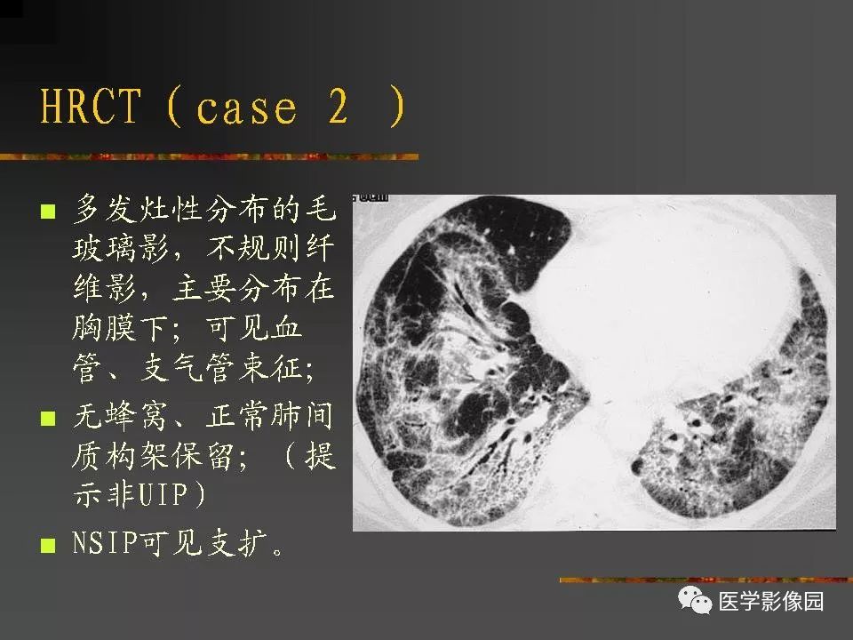【PPT】间质性肺疾病及其影像诊断