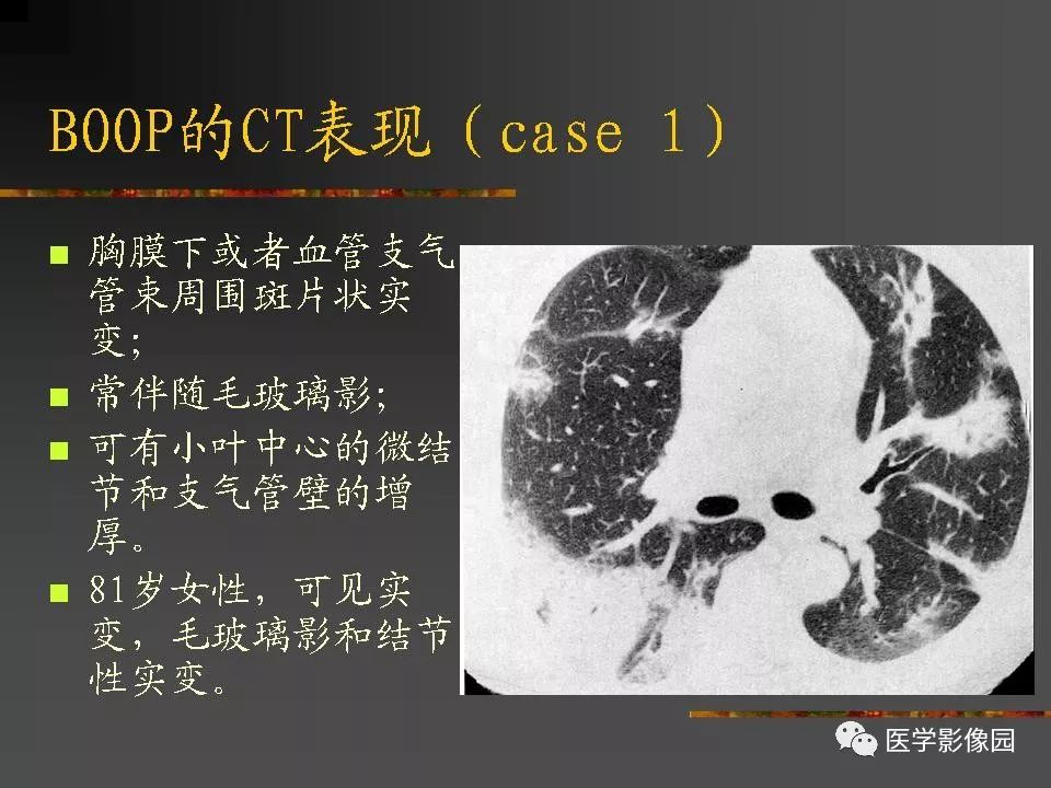 【PPT】间质性肺疾病及其影像诊断