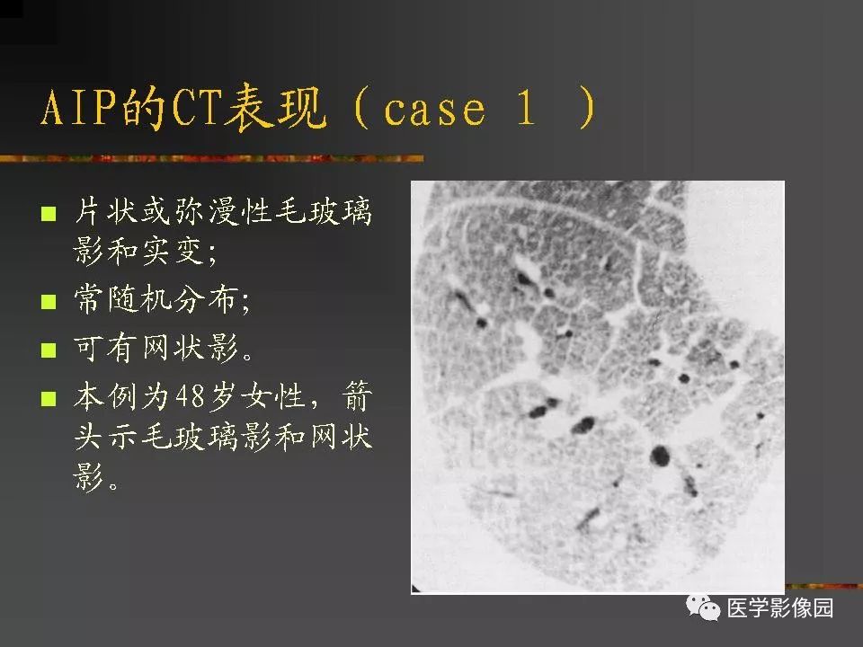 【PPT】间质性肺疾病及其影像诊断
