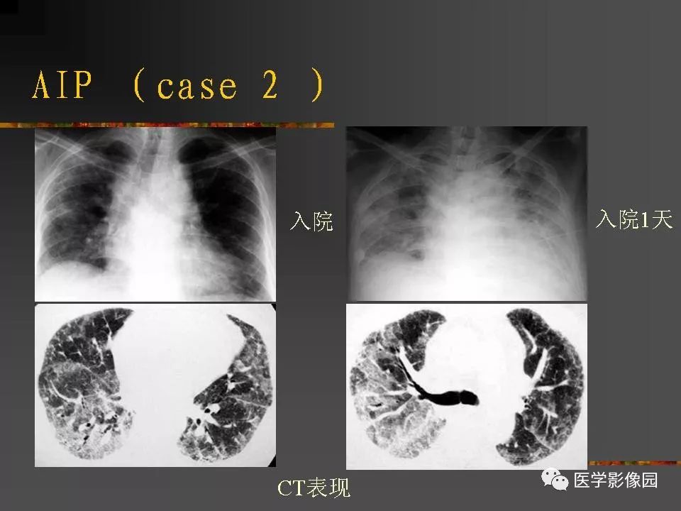 【PPT】间质性肺疾病及其影像诊断