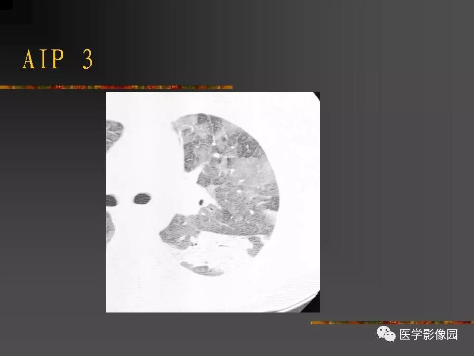 【PPT】间质性肺疾病及其影像诊断