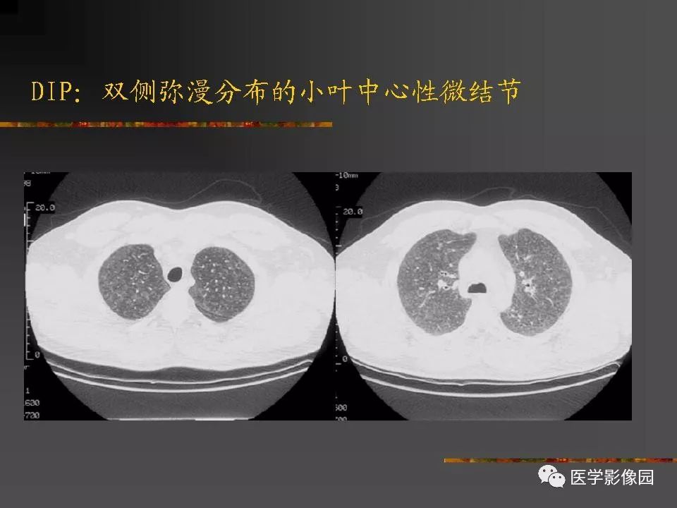 【PPT】间质性肺疾病及其影像诊断