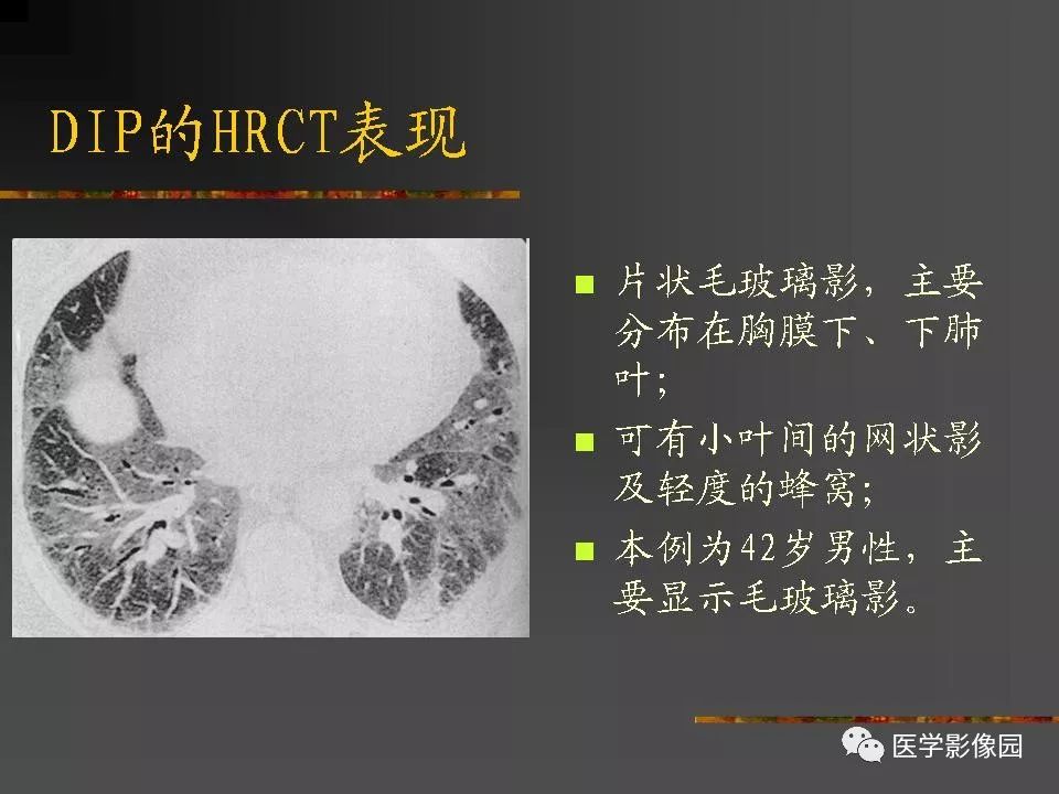 【PPT】间质性肺疾病及其影像诊断