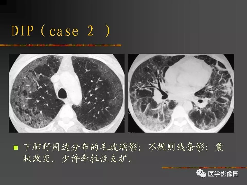 【PPT】间质性肺疾病及其影像诊断
