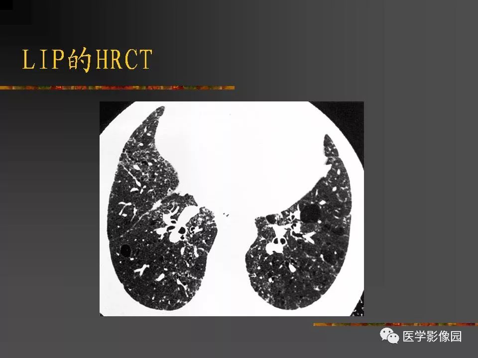 【PPT】间质性肺疾病及其影像诊断