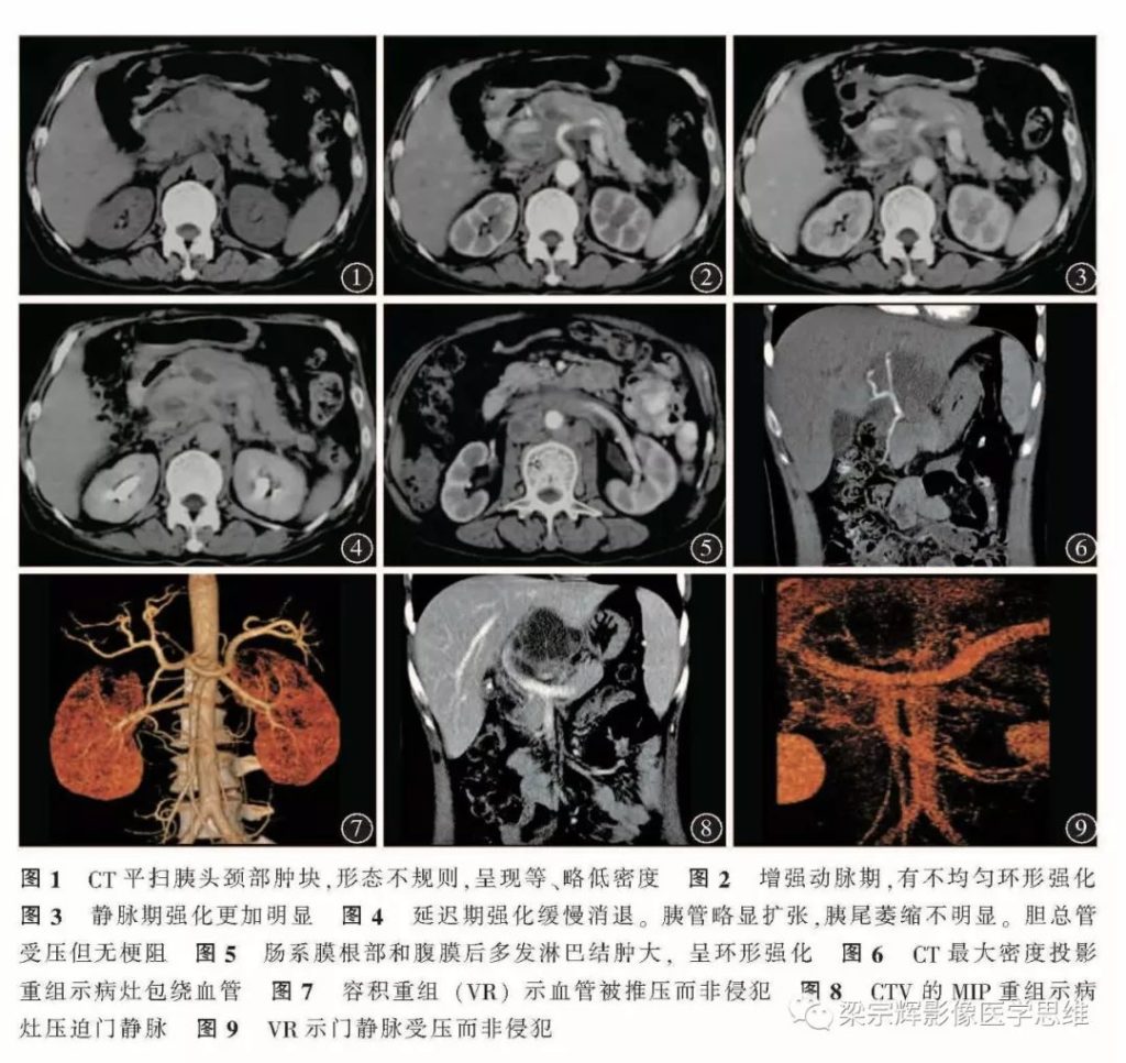 【病例】胰腺结核1例CT影像诊断思维
