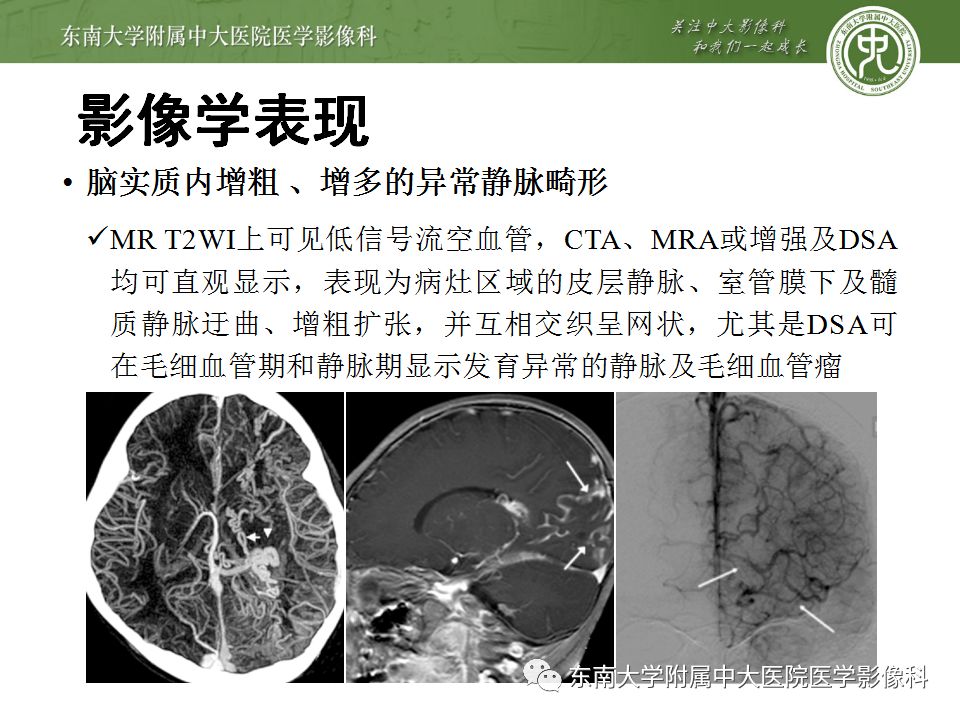 【病例】Sturge-Weber综合征2例CT及MR 【病例】Sturge-Weber综合征2例CT及MR