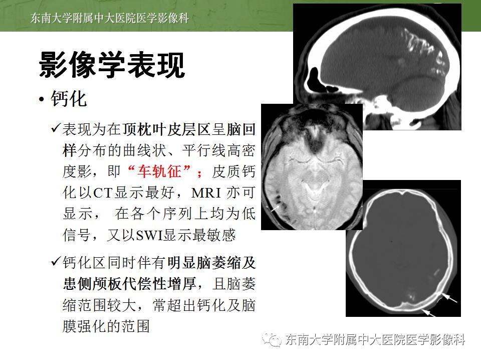 【病例】Sturge-Weber综合征2例CT及MR 【病例】Sturge-Weber综合征2例CT及MR