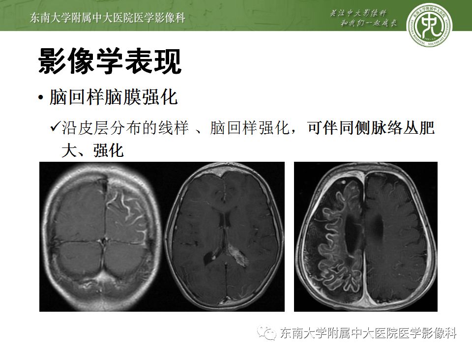 【病例】Sturge-Weber综合征2例CT及MR 【病例】Sturge-Weber综合征2例CT及MR