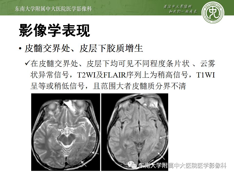 【病例】Sturge-Weber综合征2例CT及MR 【病例】Sturge-Weber综合征2例CT及MR