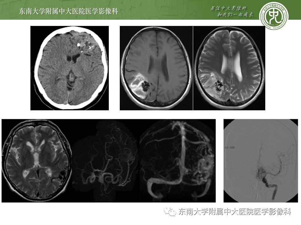 【病例】Sturge-Weber综合征2例CT及MR 【病例】Sturge-Weber综合征2例CT及MR