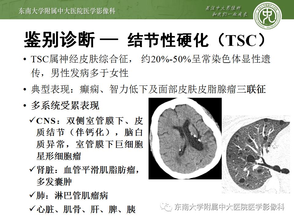 【病例】Sturge-Weber综合征2例CT及MR 【病例】Sturge-Weber综合征2例CT及MR