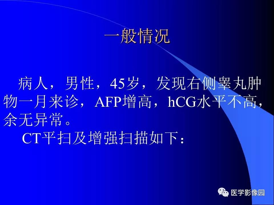 【病例】睾丸精原细胞瘤伴腹膜后转移1例CT