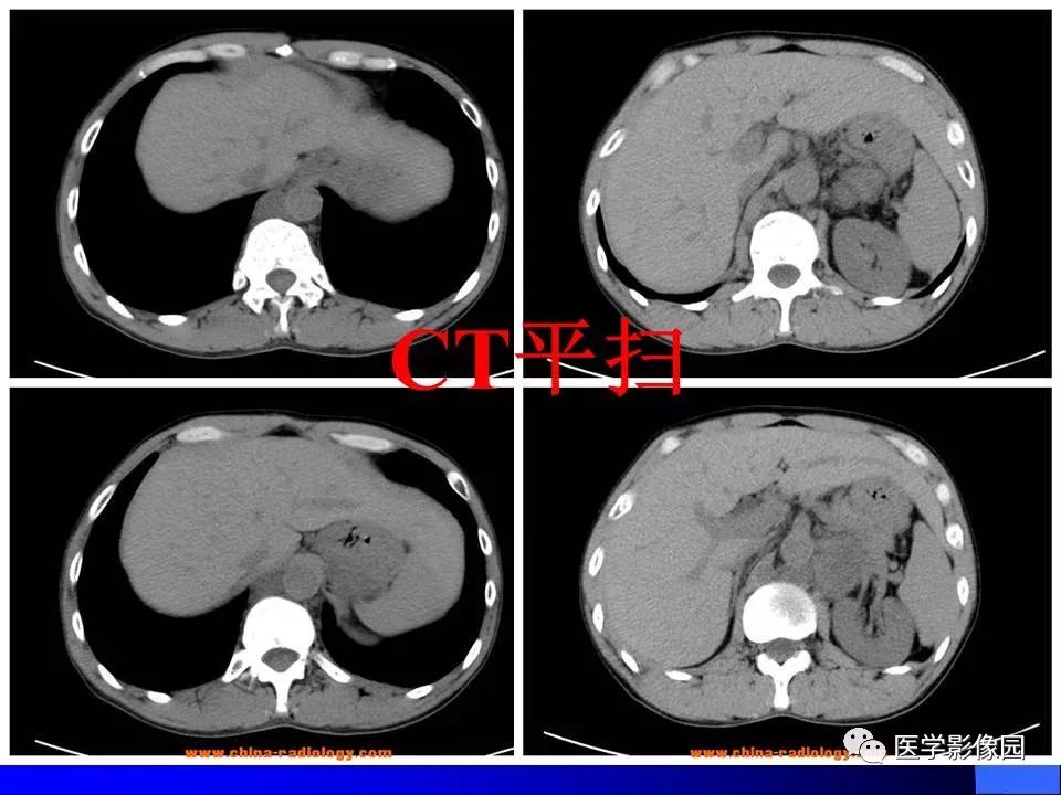 【病例】睾丸精原细胞瘤伴腹膜后转移1例CT
