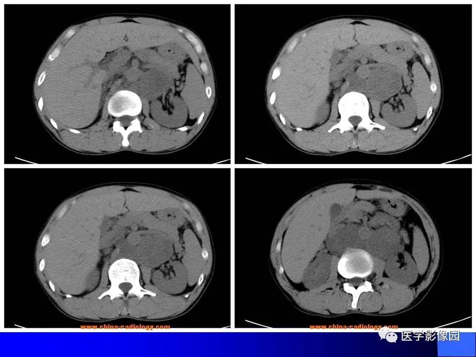 【病例】睾丸精原细胞瘤伴腹膜后转移1例CT