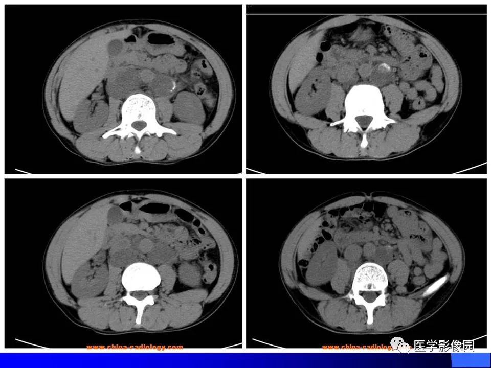 【病例】睾丸精原细胞瘤伴腹膜后转移1例CT