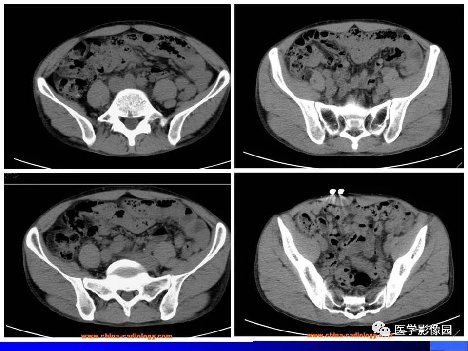 【病例】睾丸精原细胞瘤伴腹膜后转移1例CT