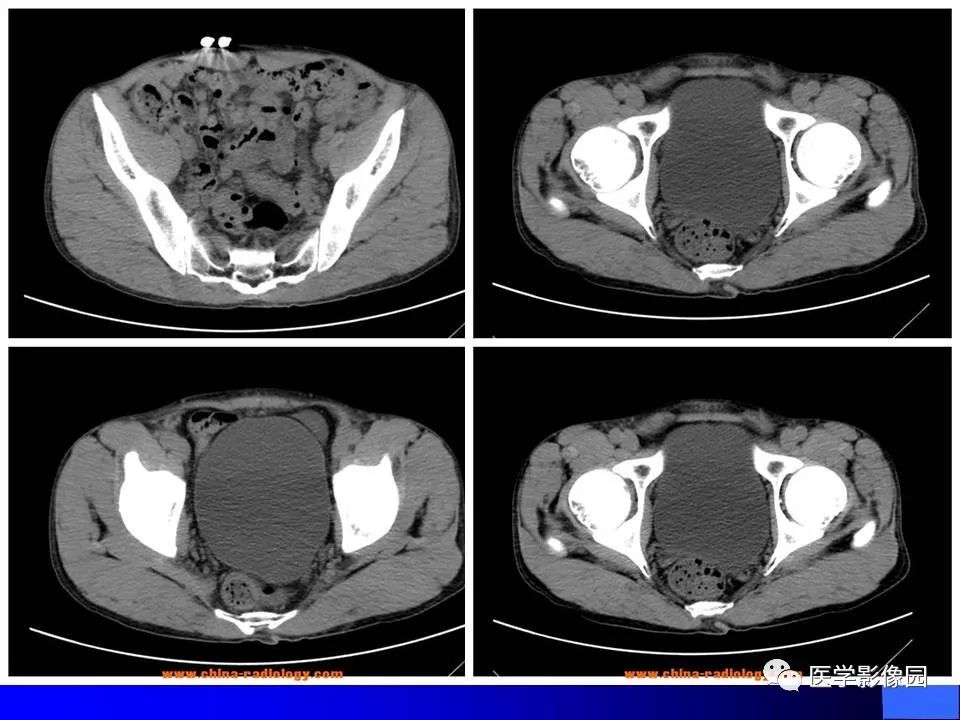 【病例】睾丸精原细胞瘤伴腹膜后转移1例CT