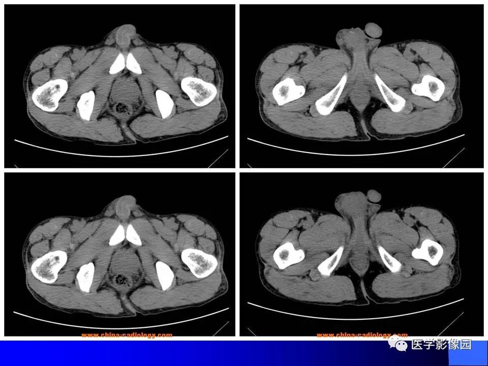 【病例】睾丸精原细胞瘤伴腹膜后转移1例CT