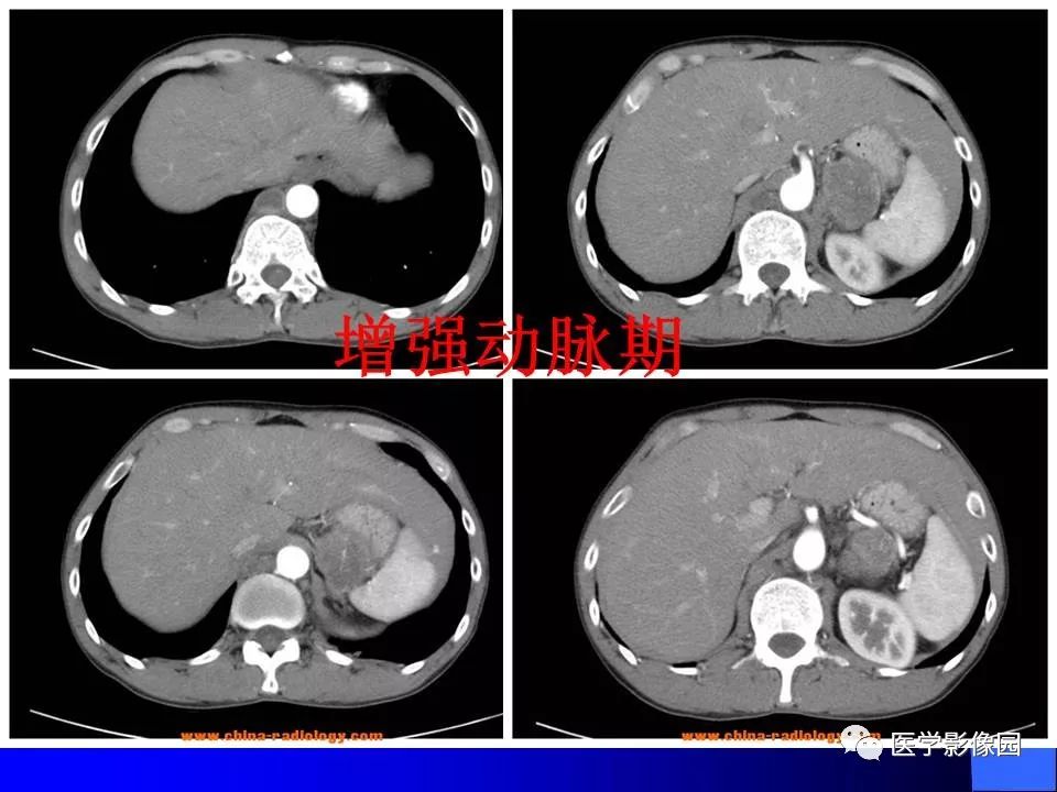 【病例】睾丸精原细胞瘤伴腹膜后转移1例CT