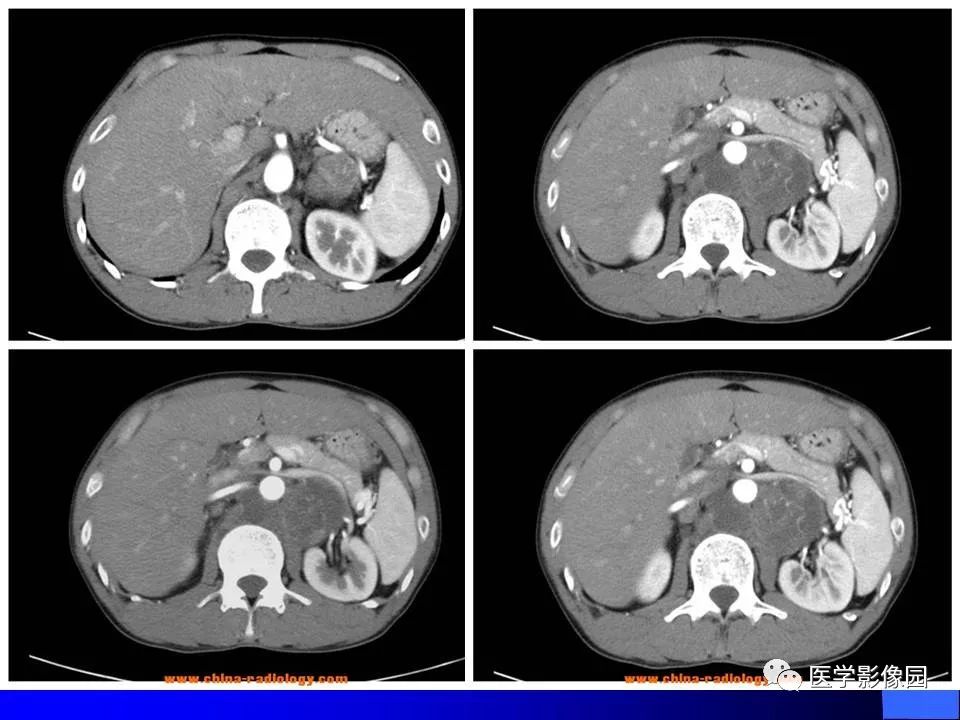 【病例】睾丸精原细胞瘤伴腹膜后转移1例CT