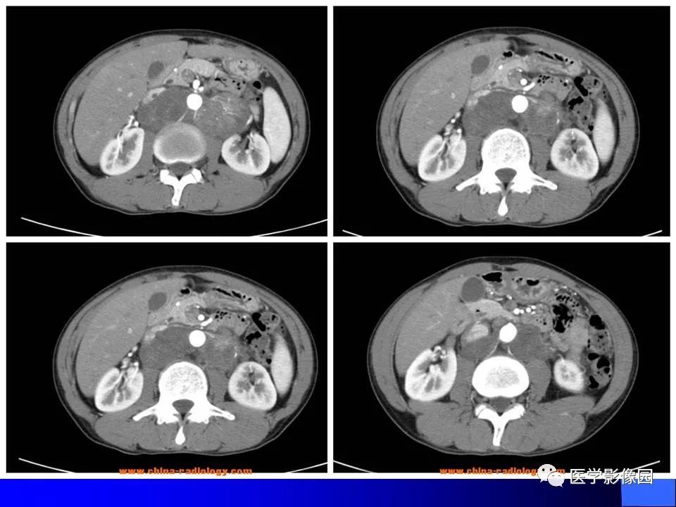 【病例】睾丸精原细胞瘤伴腹膜后转移1例CT