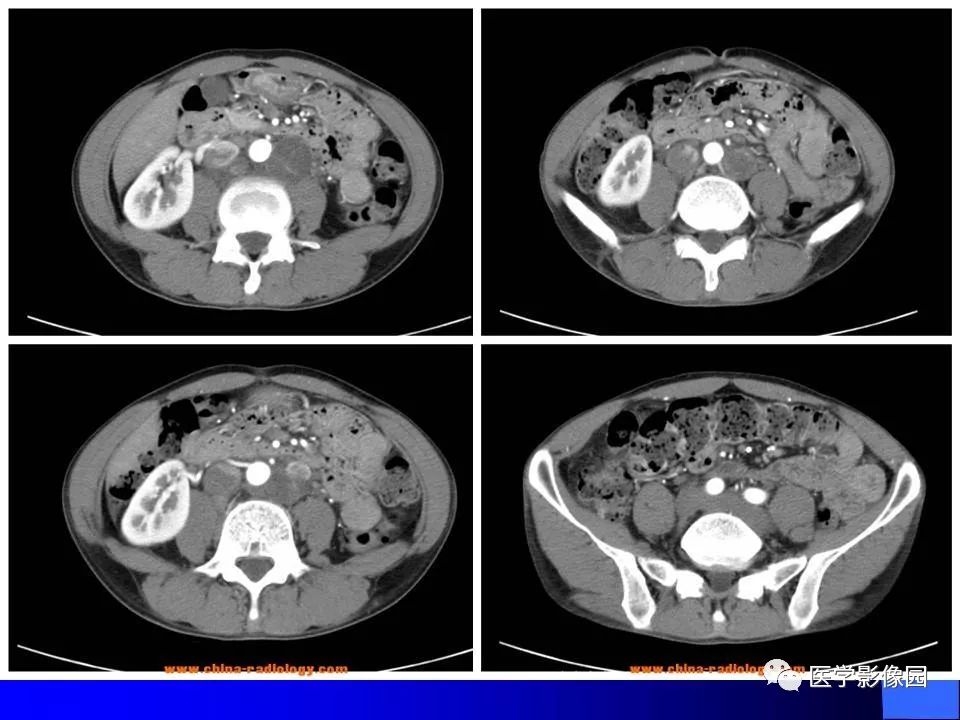 【病例】睾丸精原细胞瘤伴腹膜后转移1例CT