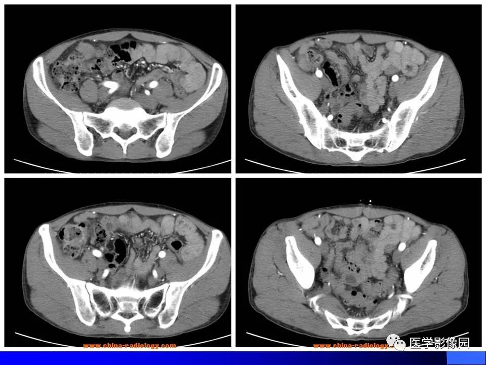 【病例】睾丸精原细胞瘤伴腹膜后转移1例CT