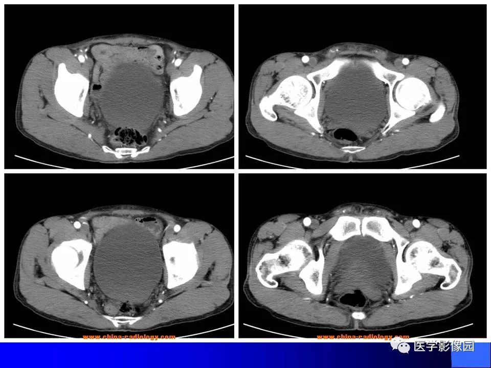 【病例】睾丸精原细胞瘤伴腹膜后转移1例CT