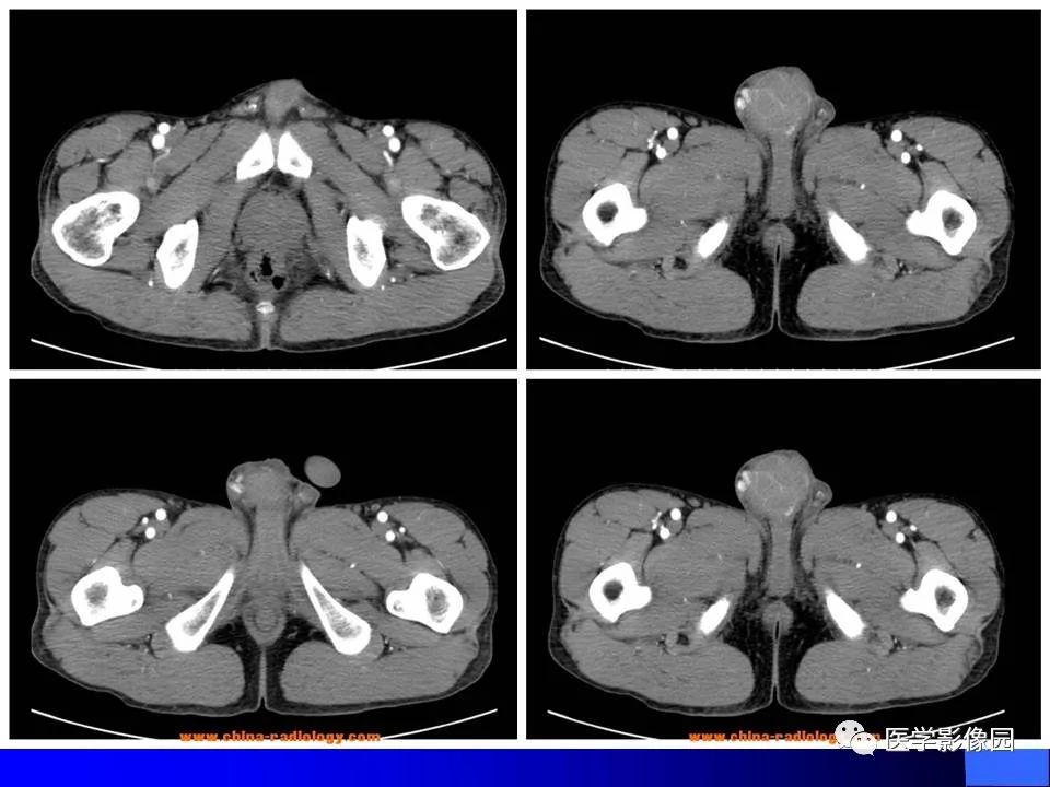 【病例】睾丸精原细胞瘤伴腹膜后转移1例CT