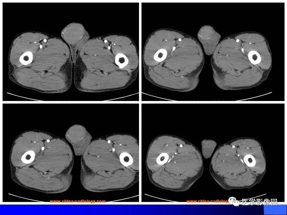 【病例】睾丸精原细胞瘤伴腹膜后转移1例CT