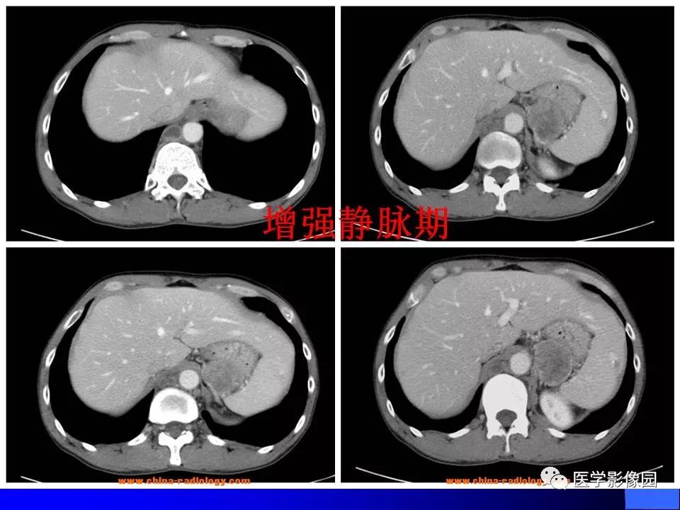 【病例】睾丸精原细胞瘤伴腹膜后转移1例CT