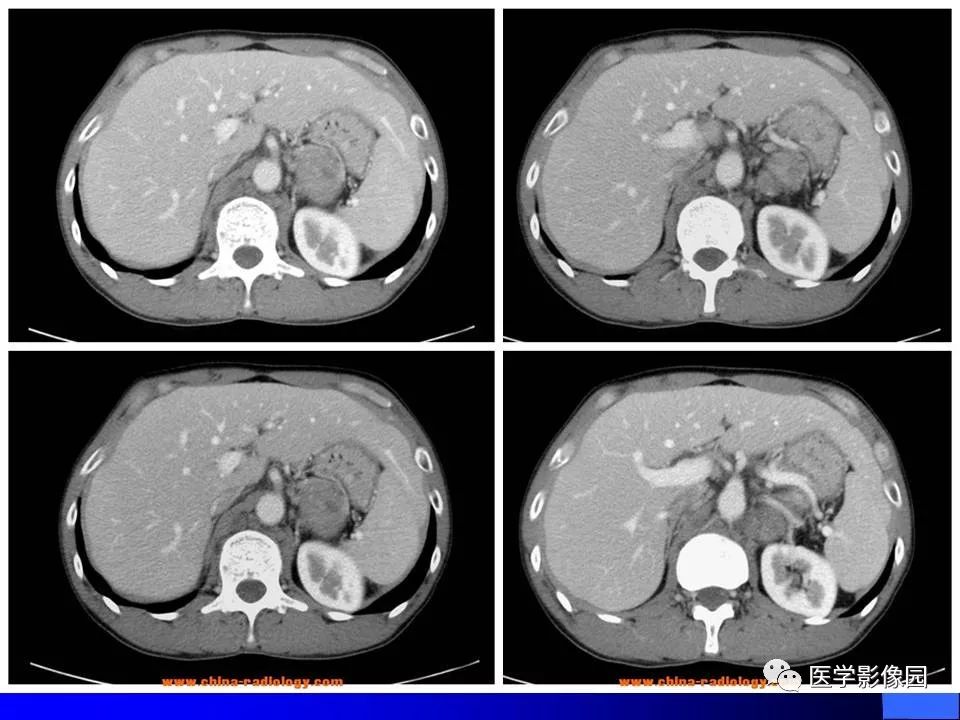 【病例】睾丸精原细胞瘤伴腹膜后转移1例CT